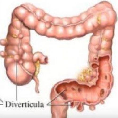 Tratamiento divertículos de colón