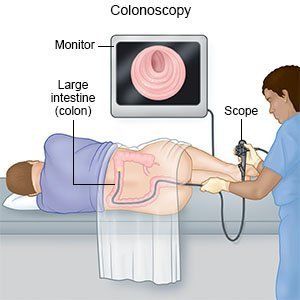 Endoscopia digestiva baja (Colonoscopia)