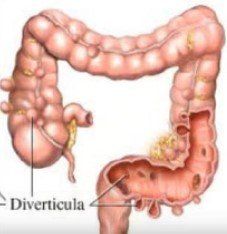 Tratamiento divertículos de colón