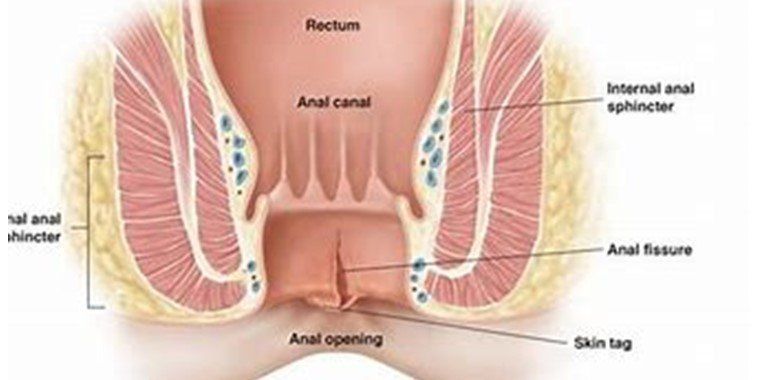 Tratamiento fisura anal