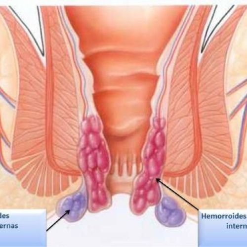 Hemorroides