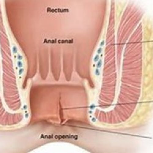 Tratamiento fisura anal